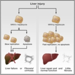 The diagram highlights the importance of the MKK4 kinase enzyme in people with liver injury. Activation of MKK4 can lead to hepatic failure and death, or severe fibrosis. This is shown on the left-hand side of the diagram. Inhibition of MKK4 accelerates the replication of hepatocytes and prevents their apoptosis, thereby permitting successful regeneration of the liver. In the worst case, inhibition of MKK4 leads to light fibrosis only. The result of MKK inhibition is shown on the right-hand side of the diagram.