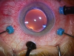 Eye surgery. The photo shows several areas from where the eye is illuminated from inside.