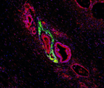 Das Foto zeigt einen Gewebeschnitt, auf dem immunhistologisch angefärbte angefärbte Pankreaskarzinomzellen zu sehen sind.